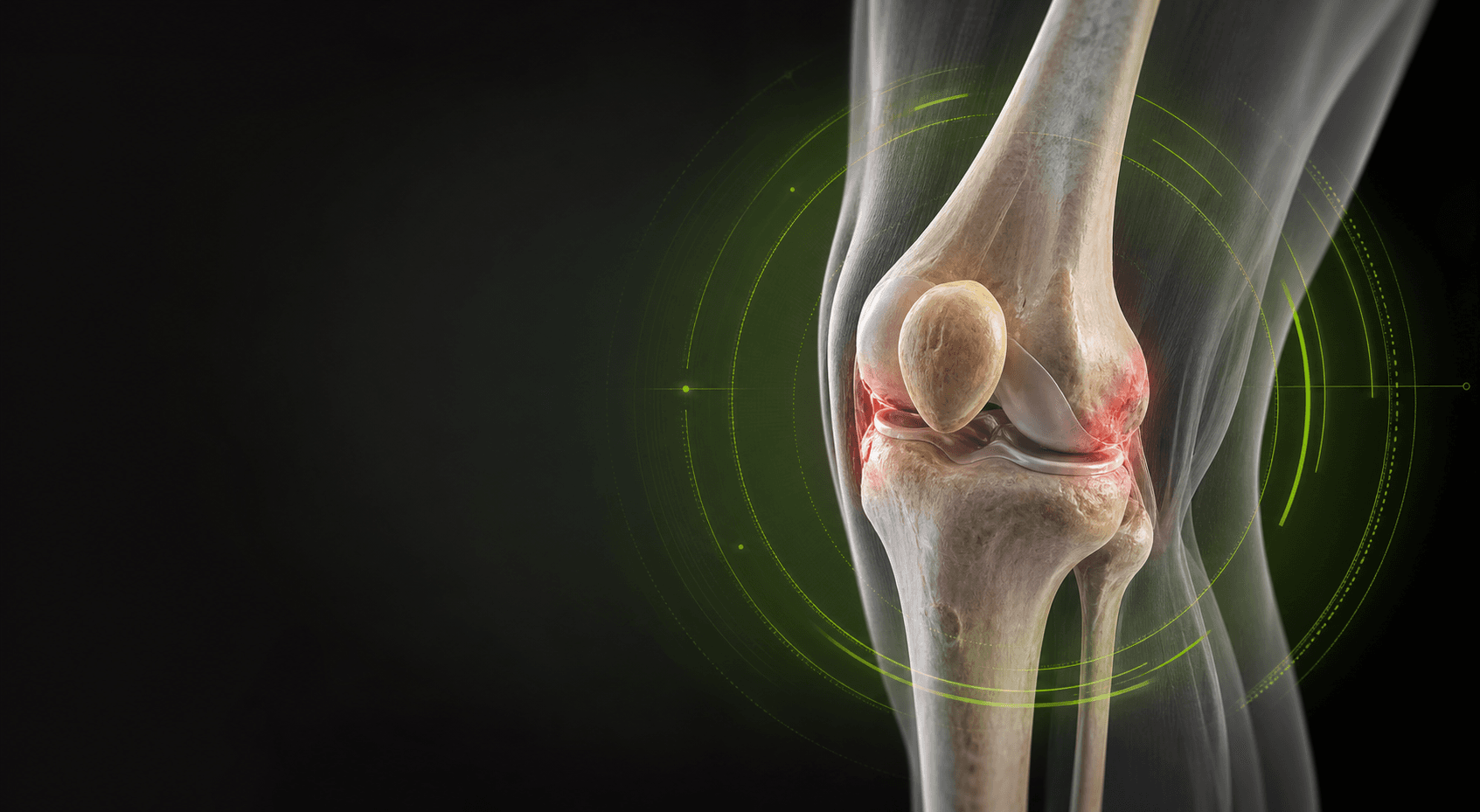 Translucent 3D anatomy illustration of a knee joint affected by arthritis