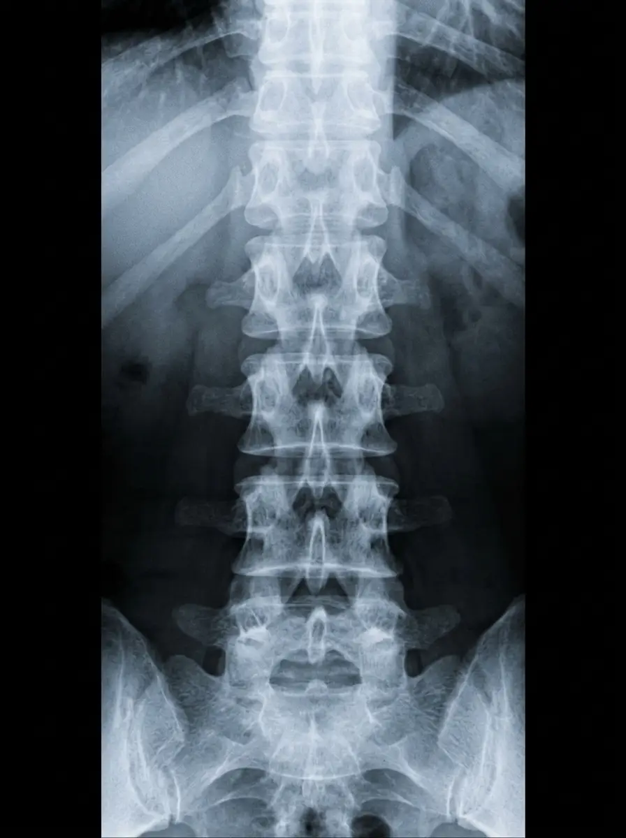 Digital X-ray of a lumbar spine